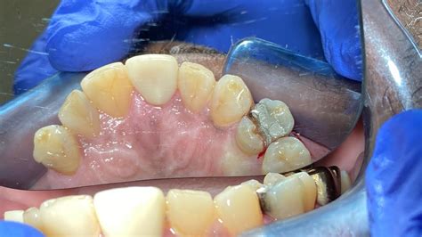 Rodogyl works better for soft tissue gum infections caused by debris retention and subsequent gingivitis and initial stages of gum disease. . How to tell if tooth is cracked after root canal